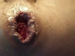 man-cunt gaping prolapse anal hole stretched asshole