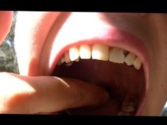 Summers Throat Uvula and Gag Reflex