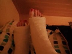 wiggling toes sticking out of two fresh plaster casts